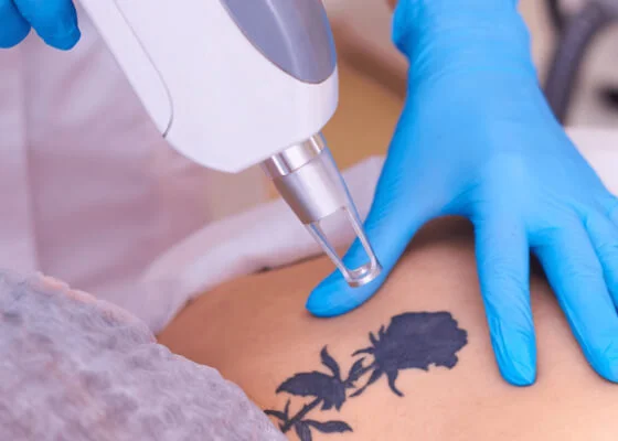 Tattoo Removal-in-Christi, TX