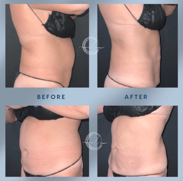 oceanaluxemedspa coolsculpting before and after smaller in christi