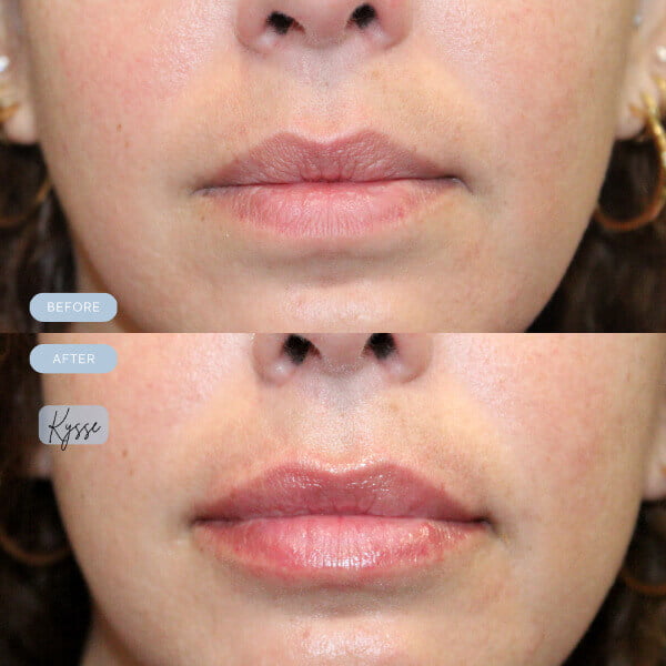 oceanaluxemedspa lip attaction newblog in christi