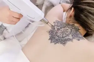 Pico Laser Tattoo Removal