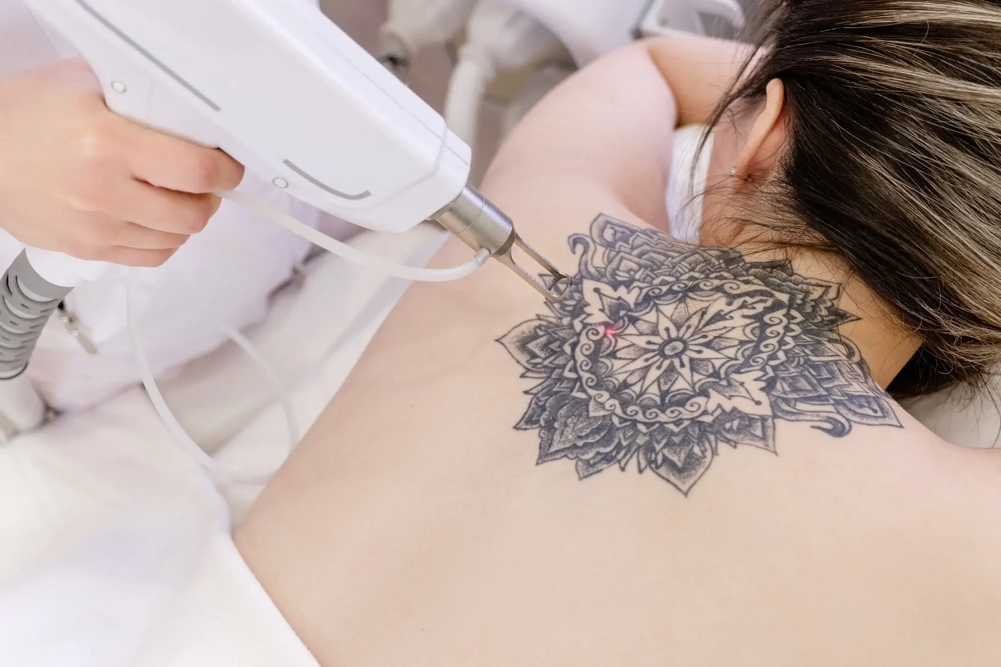 Pico Laser Tattoo Removal