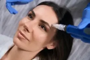 CO2 Laser Skin Resurfacing